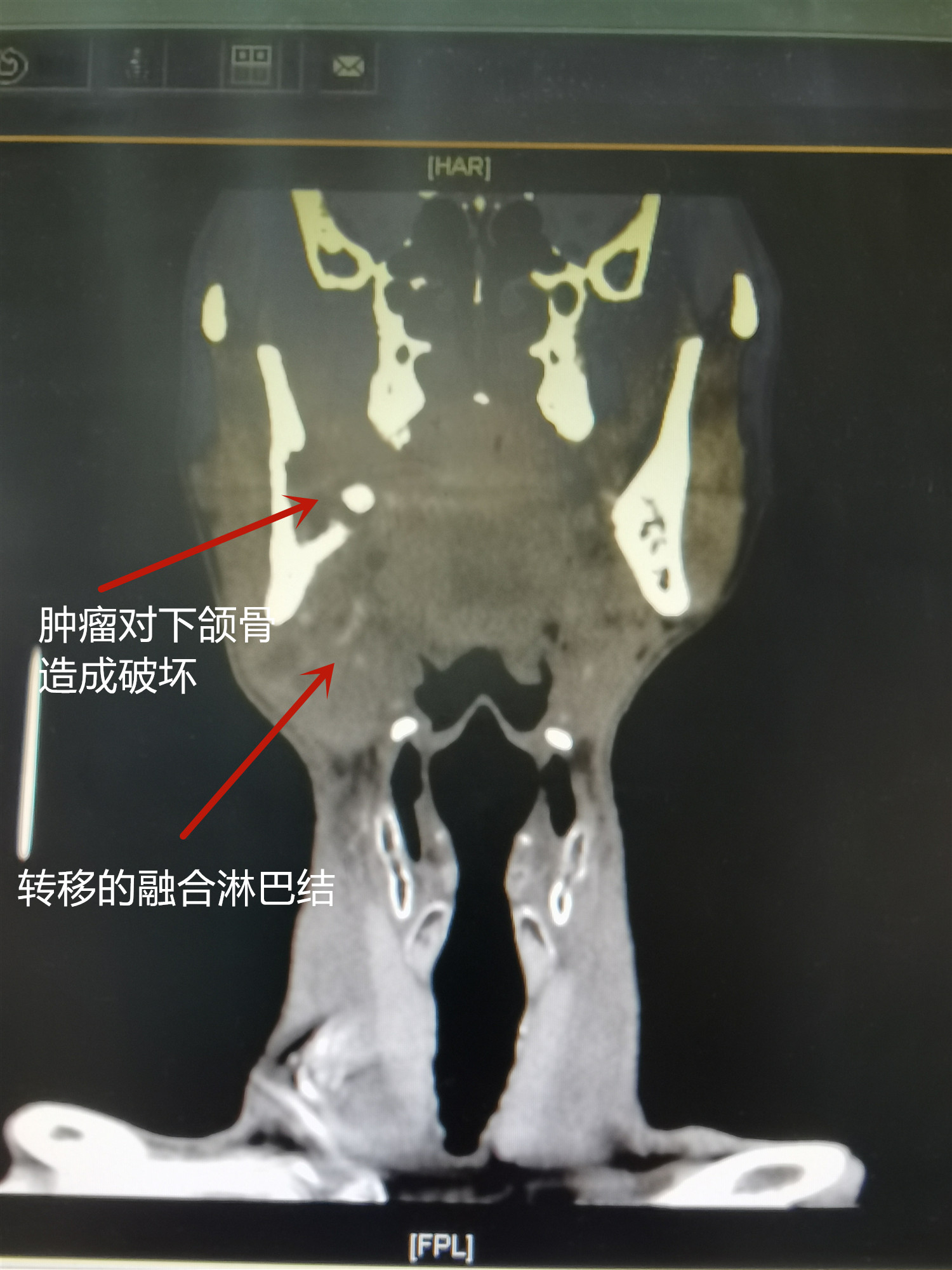 吃药也不管用？警惕迁延不治的牙疼“成为”口腔癌