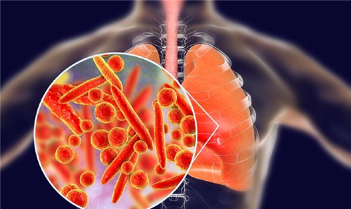 支原体肺炎症状有哪些？如何防治秋季呼吸道疾病？
